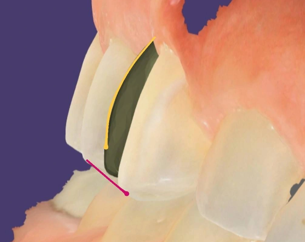 Digital design of an implant crown for a maxillary first premolar, with markings showing the deficient buccal contour and cusp height relative to the adjacent teeth
