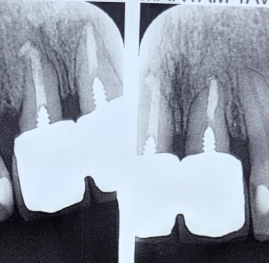 Periapical radiograph of the anterior teeth showing severely short roots