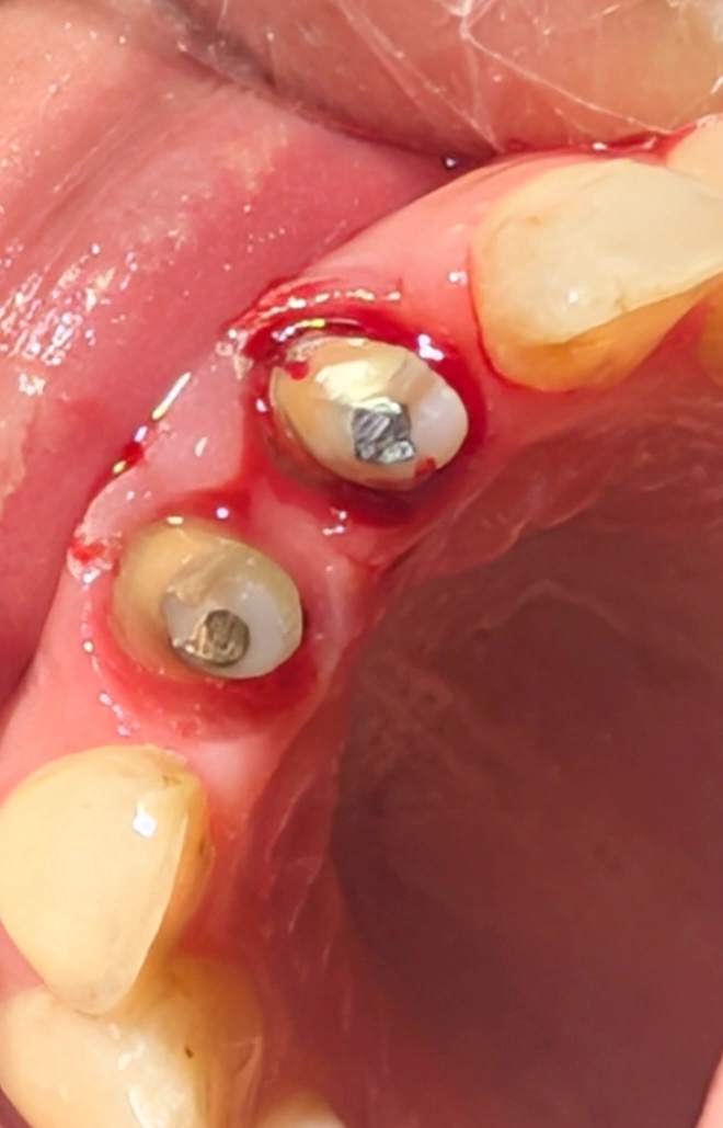 Intraoral view of the prepared teeth after removal of the previous crowns, showing improper, unsystematic palatal preparation