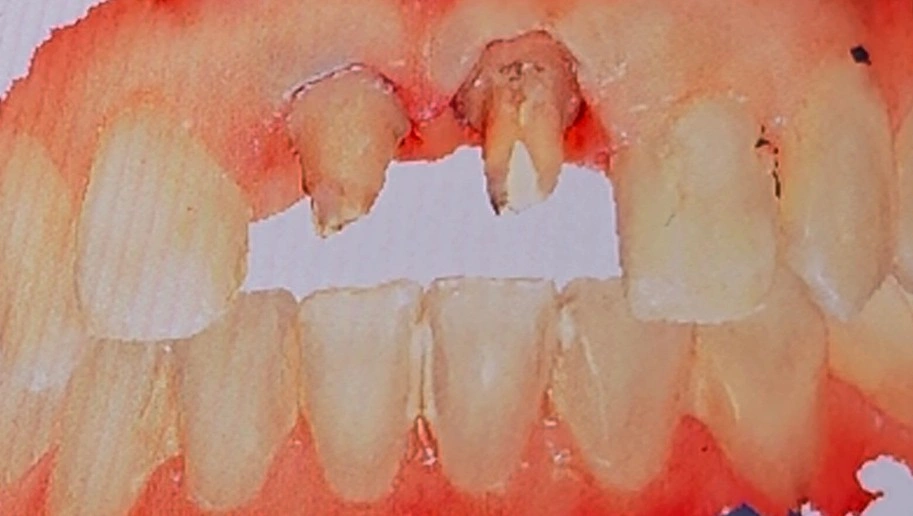 Two adjacent anterior preparations with inflamed, bleeding soft tissue around them, cord-free, before a digital scan