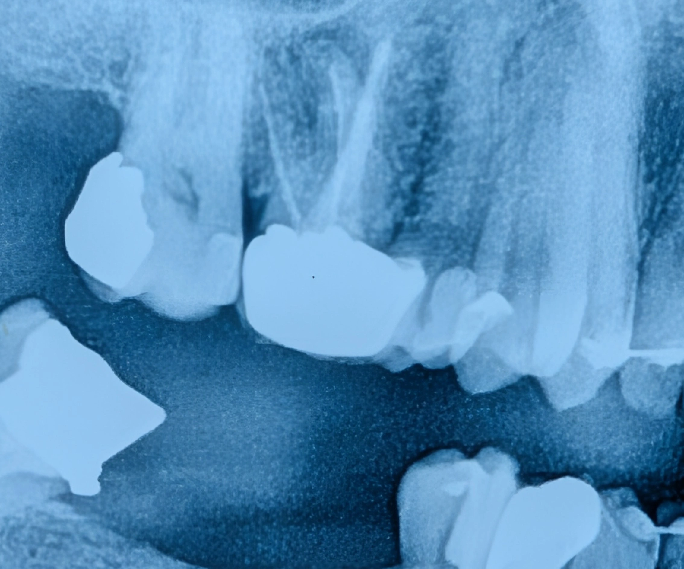 عکس پانورامیک دندان‌ها (OPG)