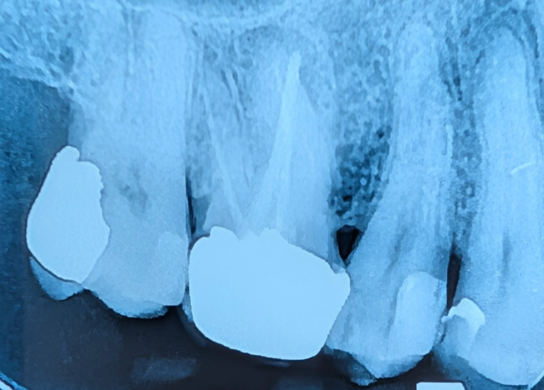 رادیوگرافی PA دندان‌های خلفی