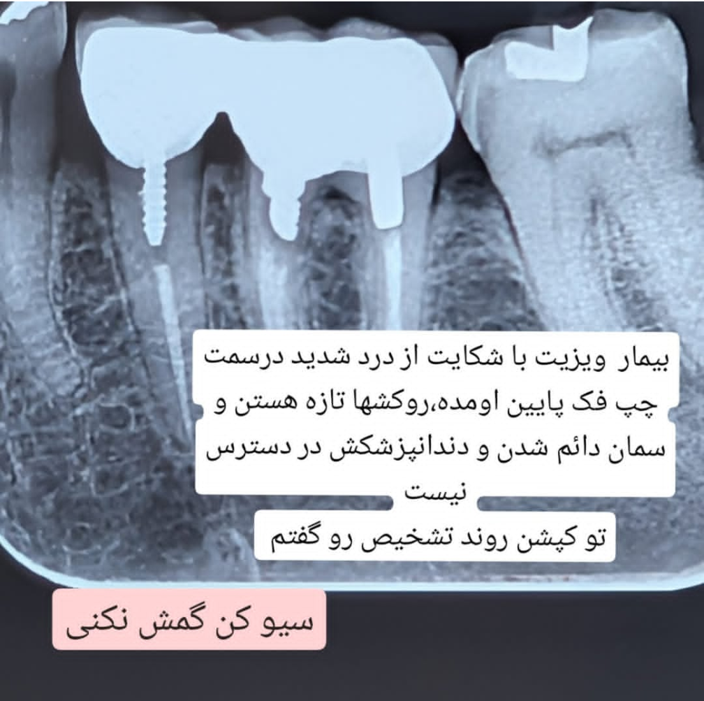 رادیوگرافی دندان ۶ با روکش تازه و تماس ضعیف دیستال