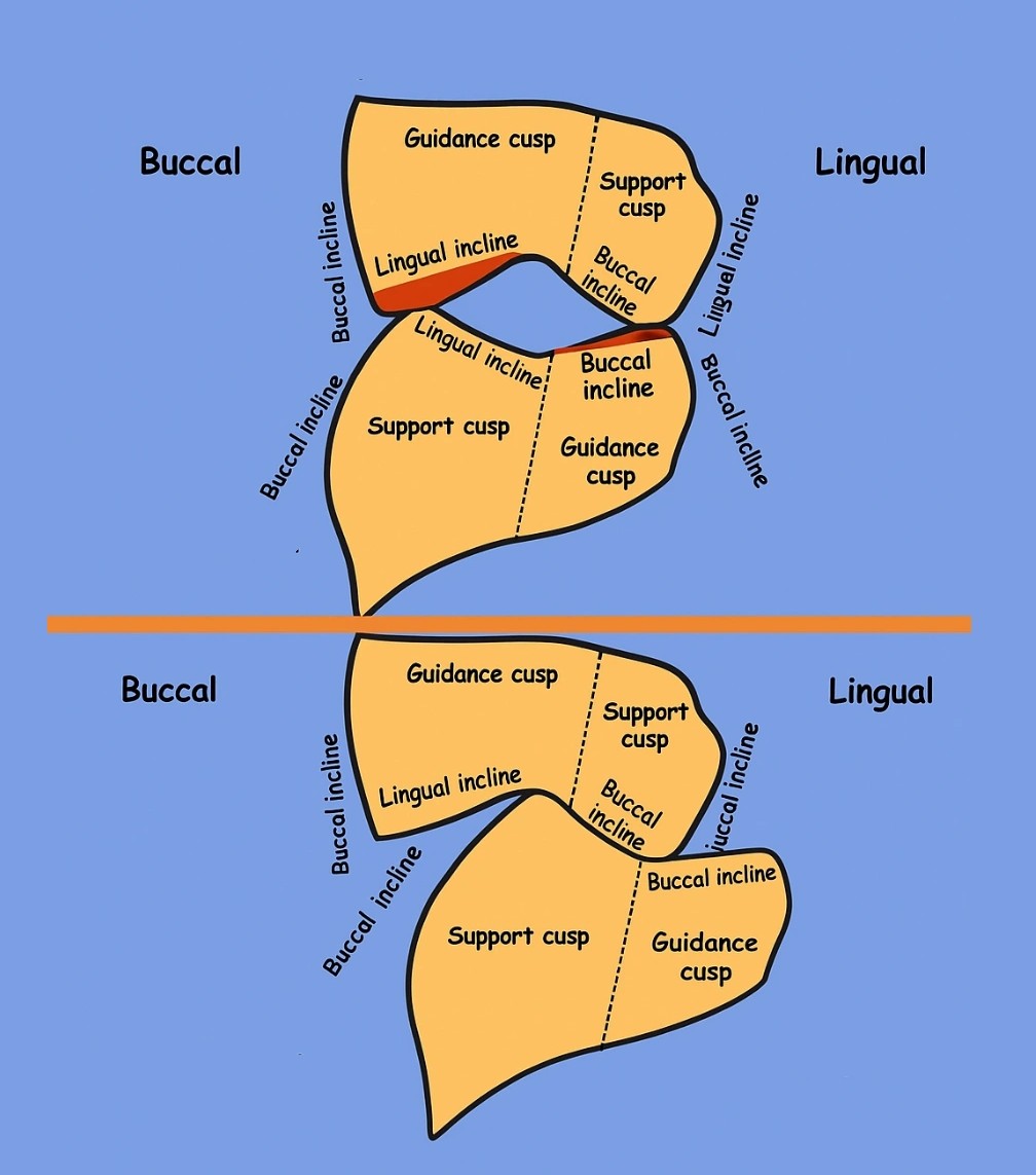 نمای شماتیک قانون BULL در تنظیم اکلوزال؛ Buccal Upper و Lower Lingual