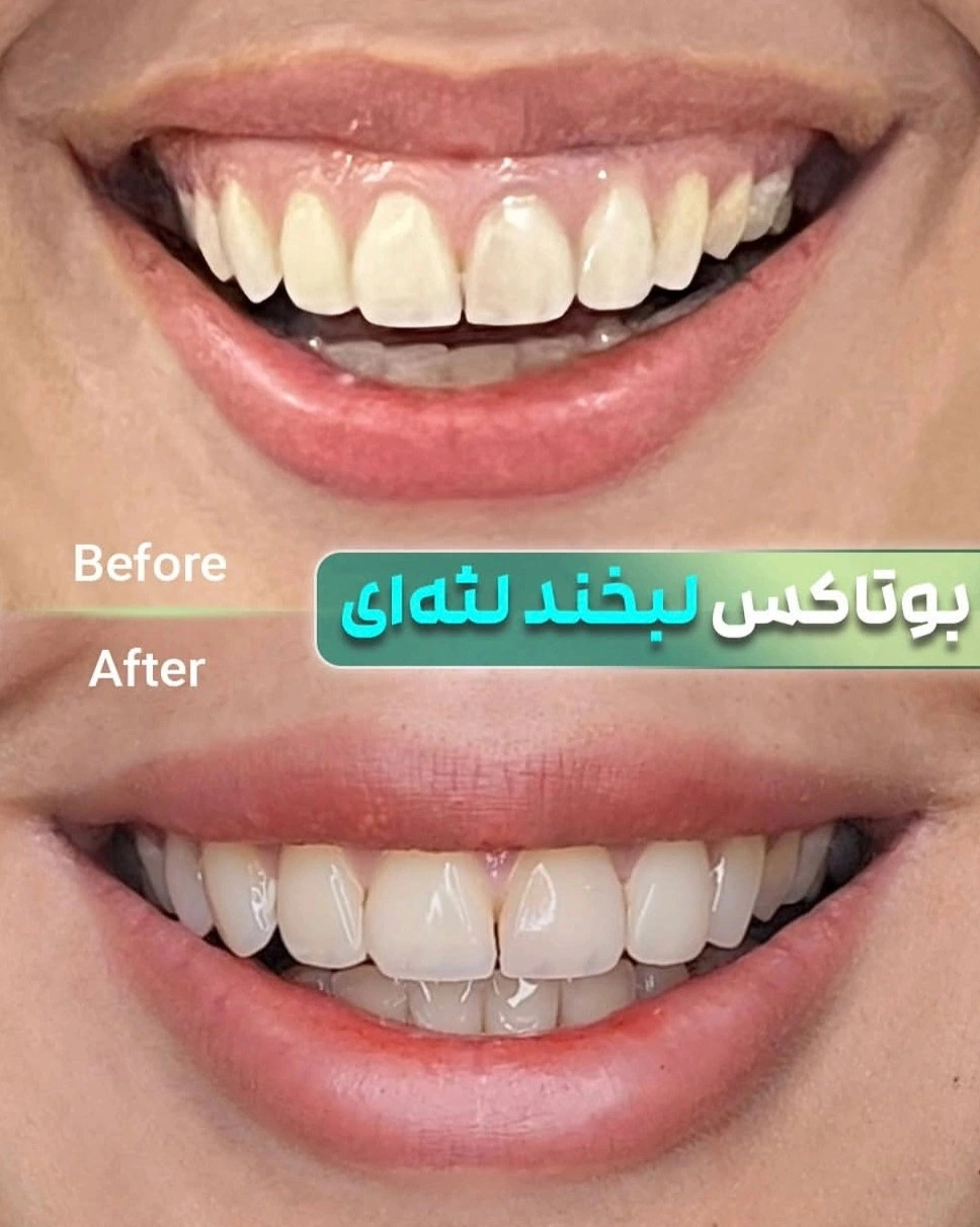 قبل و بعدِ درمانِ بوتاکسِ لبخند لثه‌ای