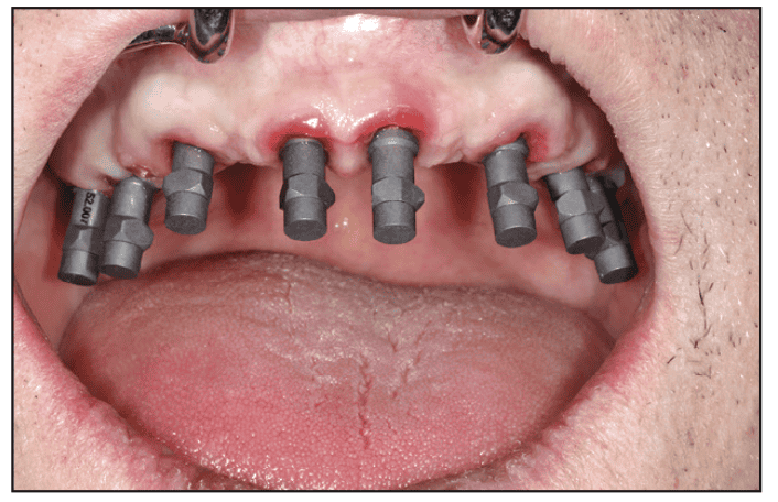 اسکنر داخل دهانی در حال کار