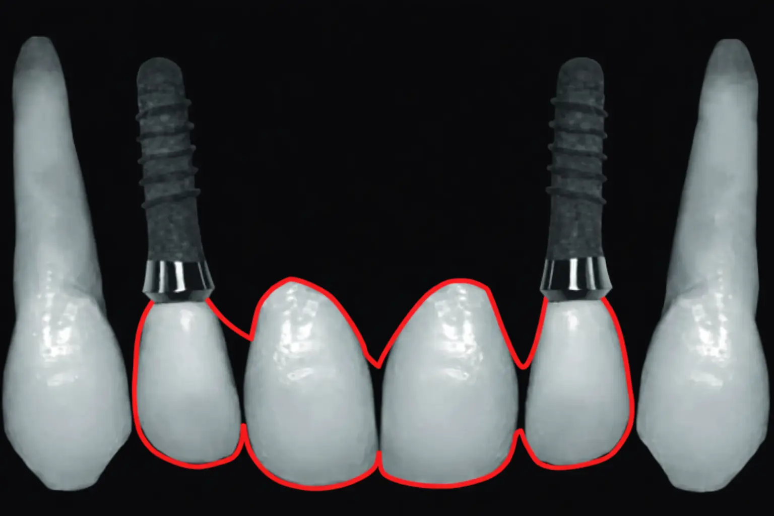 جایگذاری ایمپلنت در ناحیه قدامی فک بالا