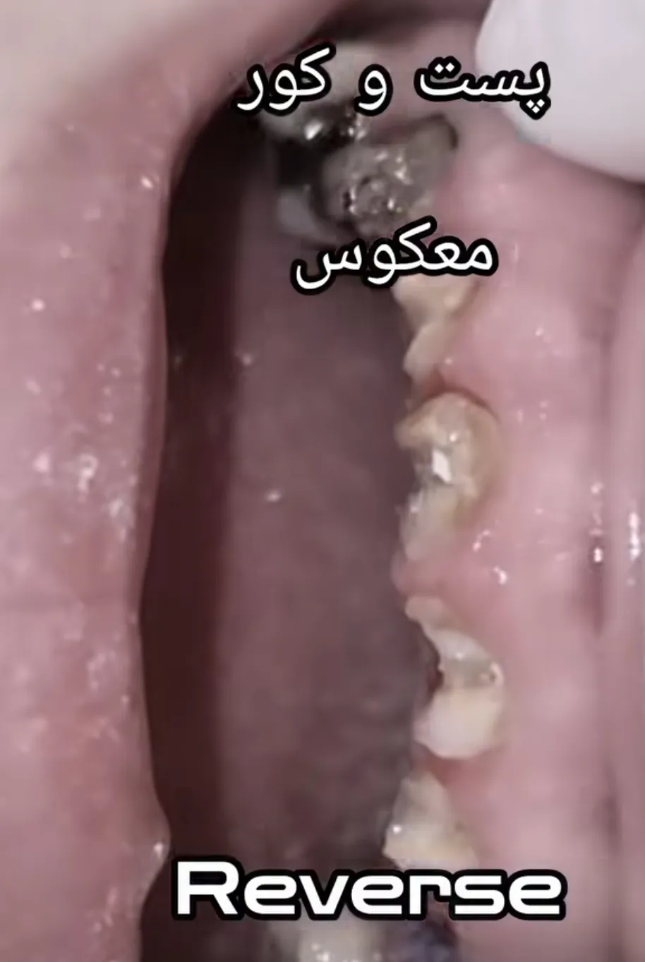 دندان‌های قدامی پوسیده و تخریب‌شده بعد از خارج کردن روکش‌ها